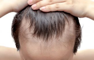 A Hair Loss Solution For Steady Balding