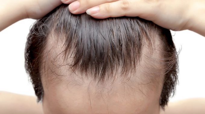 A Hair Loss Solution For Steady Balding