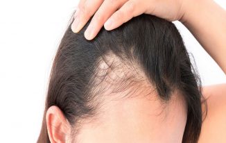 Dealing With the Hair Loss of Women