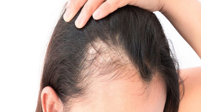 Dealing With the Hair Loss of Women