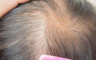 Hair Loss – Some Causes And Treatments For Women