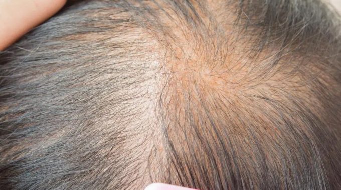 Hair Loss – Some Causes And Treatments For Women