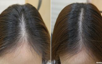 hair loss remedy for females - Concerns and Remedies