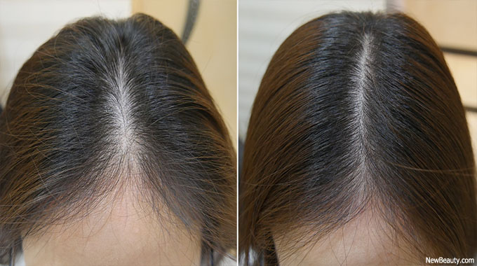 hair loss remedy for females – Concerns and Remedies