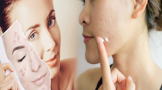 How to Get Acne Free Skin Naturally